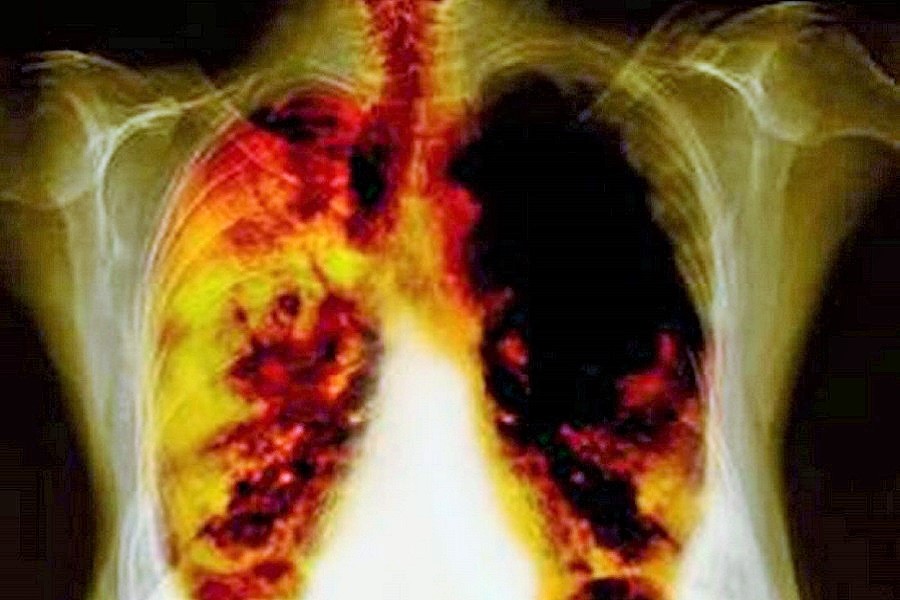 cigarrillo-cancer-pulmon